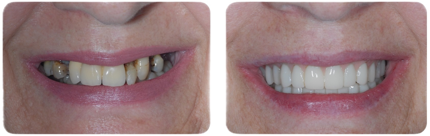 Same-day All-on-6 before and after smile transformation