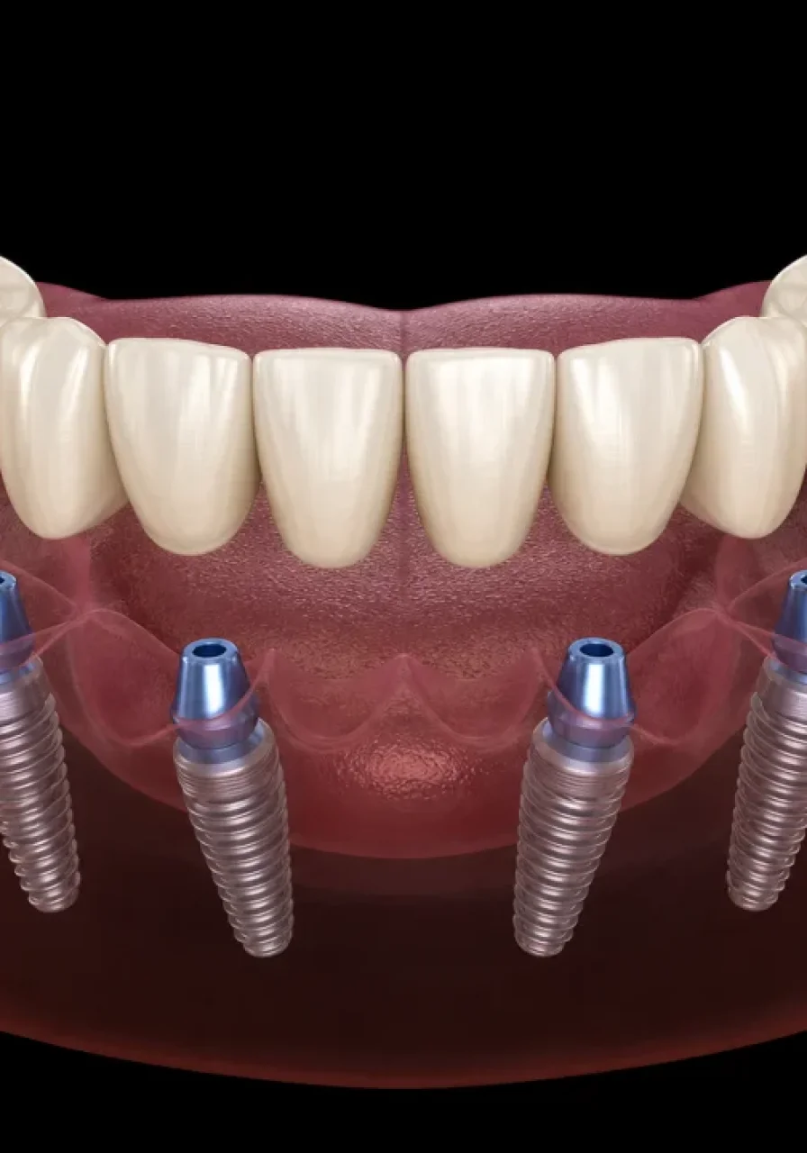 Implant placement procedure