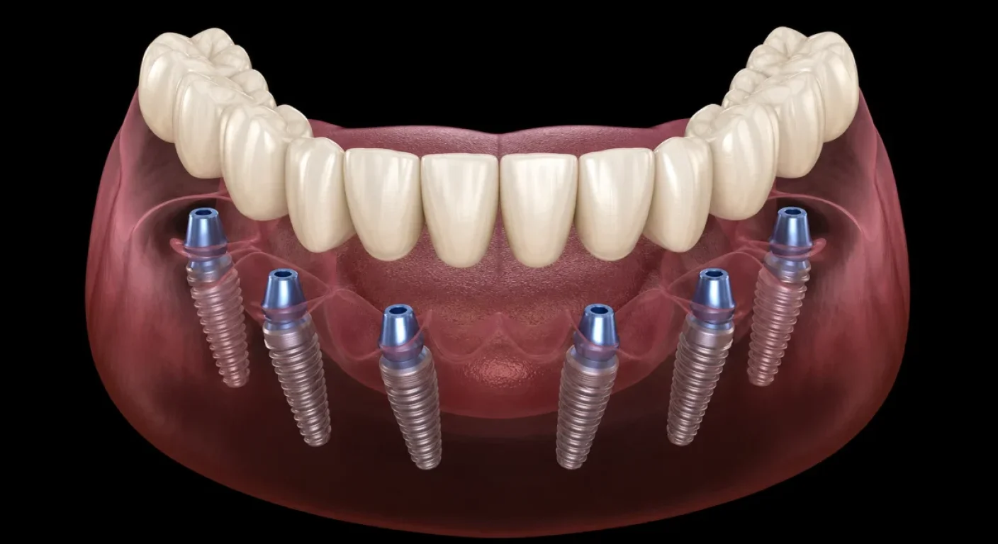 All-on-6 implant restoration procedure