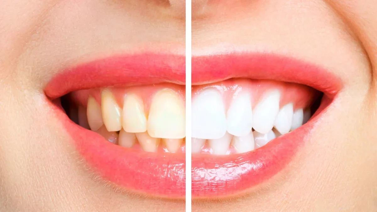 Teeth Whitening