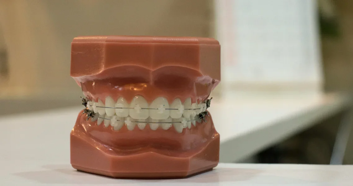 Straight teeth with braces