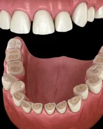 Patient after bridge placement