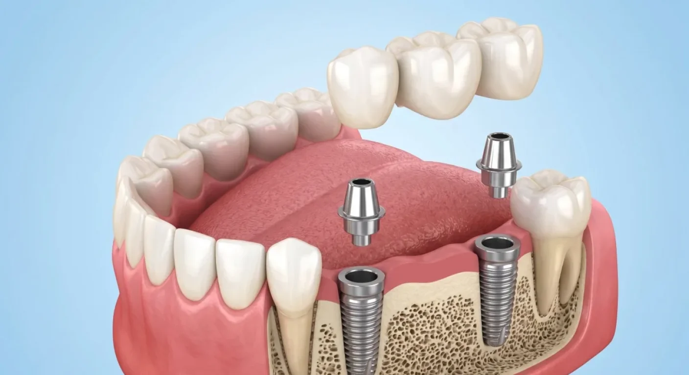 Multiple Implant Bridge