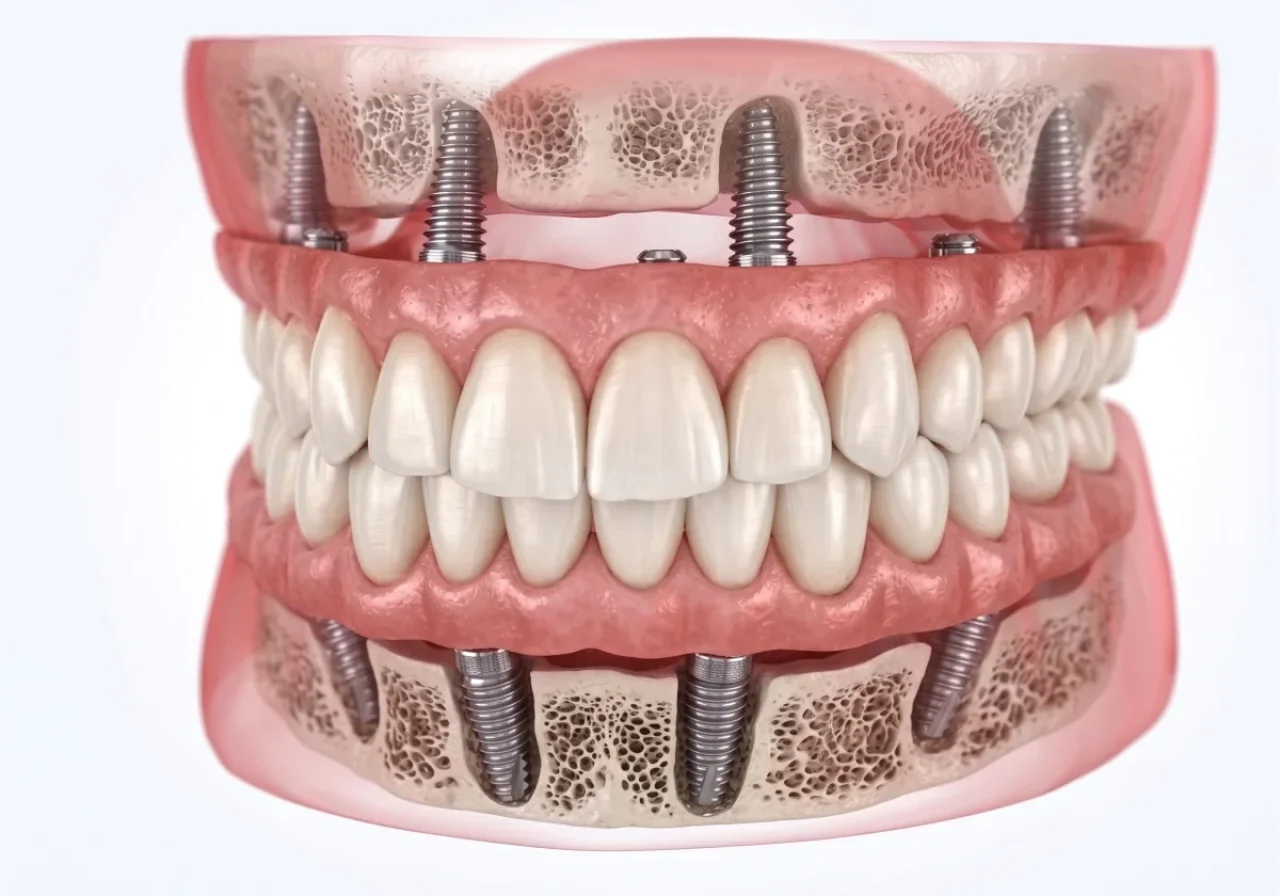All-on-4 Implants