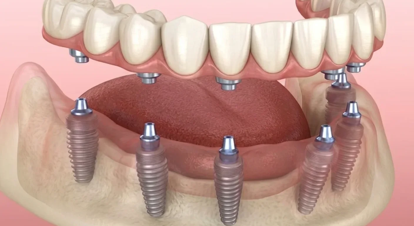 Dental Implants