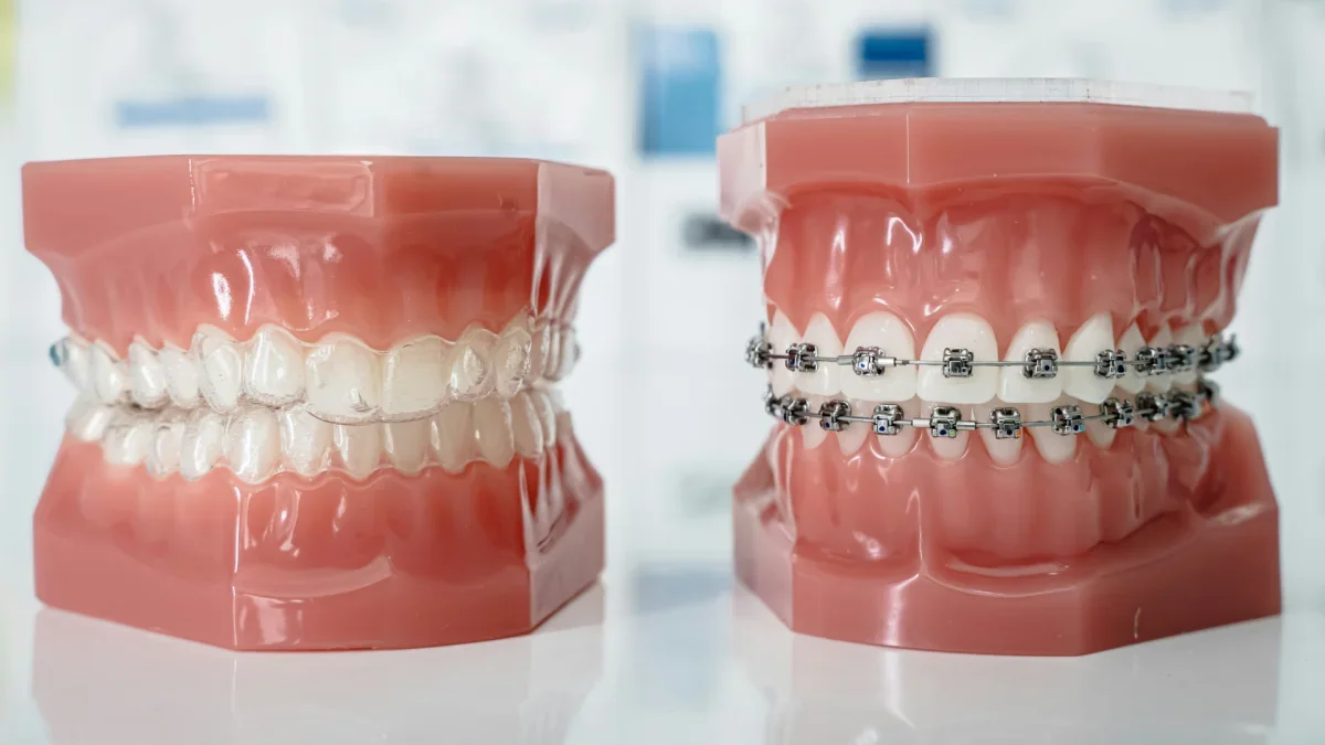 Digital orthodontic treatment planning