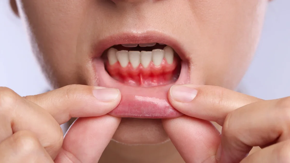 Periodontal Treatment
