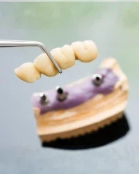 Dental bridge tooth replacement