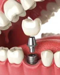 Dental implant replacement after extraction