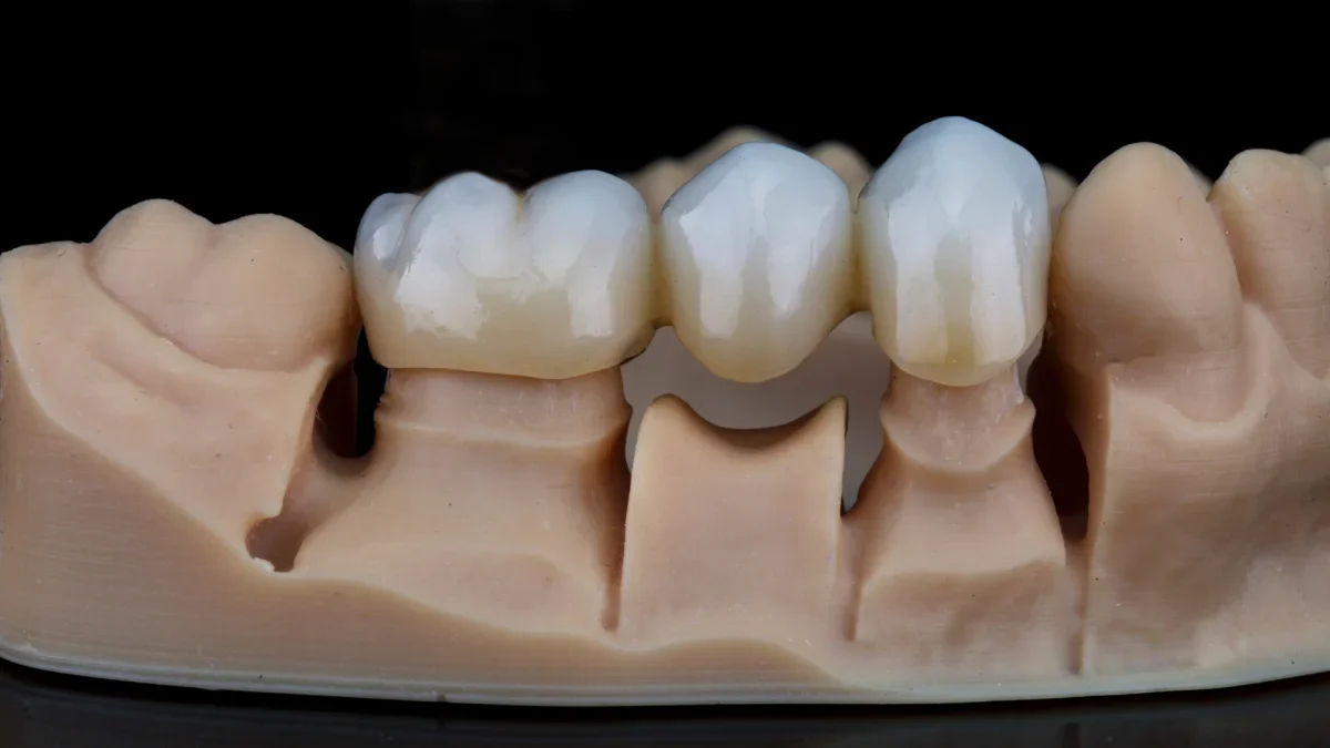 Dental Crowns