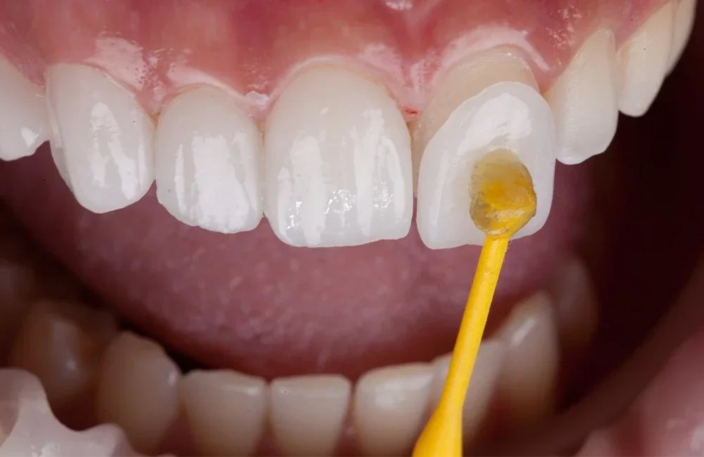 Porcelain Veneers
