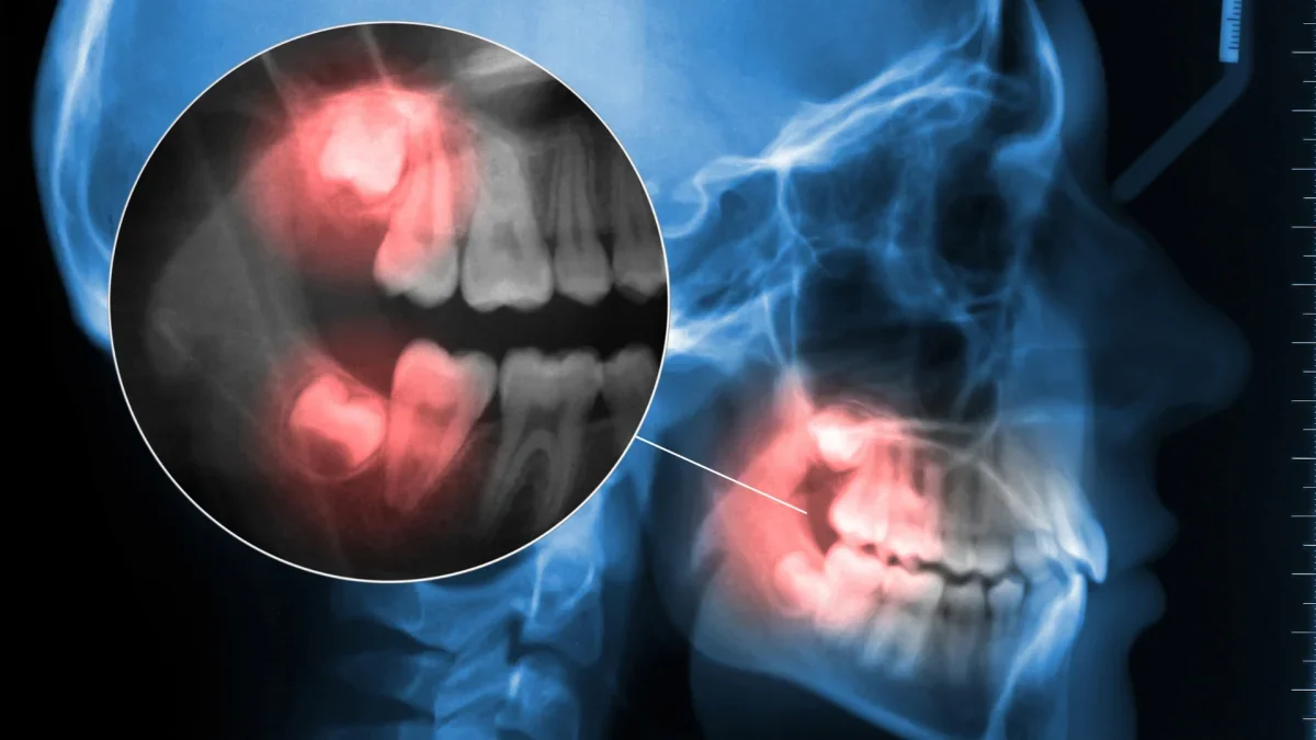 Young patient with wisdom teeth