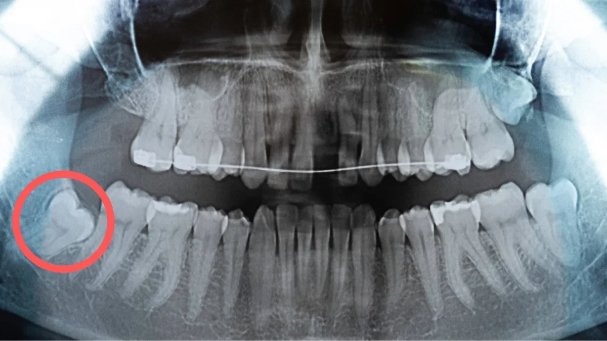 Impacted tooth assessment